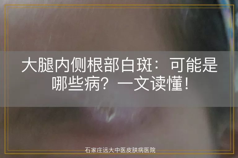 大腿内侧根部白斑：可能是哪些病？一文读懂！