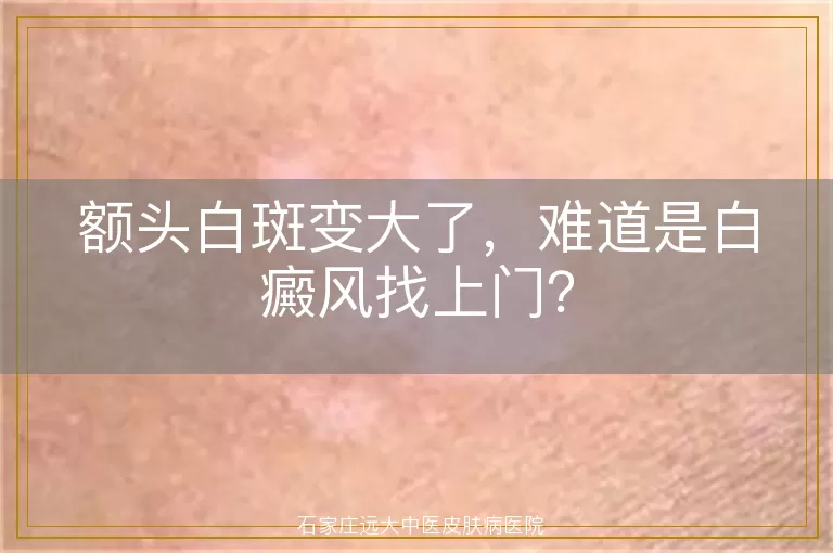 额头白斑变大了，难道是白癜风找上门？