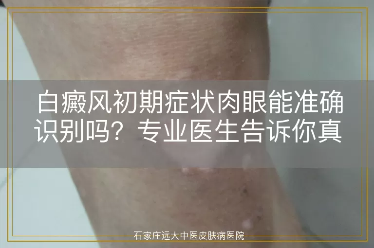 白癜风初期症状肉眼能准确识别吗？专业医生告诉你真相