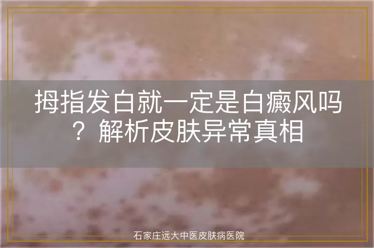 拇指发白就一定是白癜风吗?解析皮肤异常真相