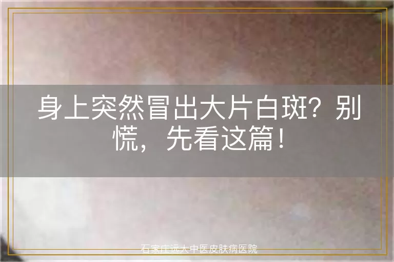 身上突然冒出大片白斑？别慌，先看这篇！
