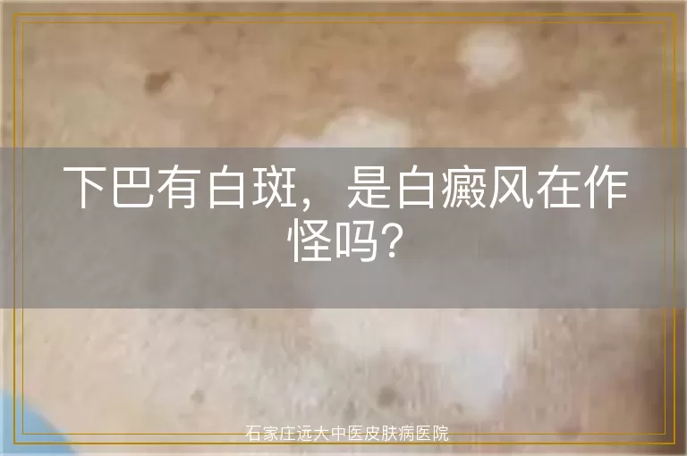 下巴有白斑，是白癜风在作怪吗？