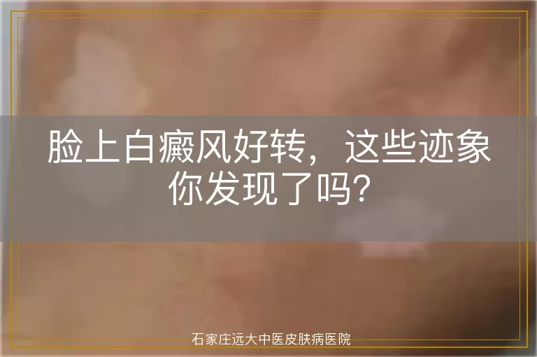 脸上白癜风好转，这些迹象你发现了吗？