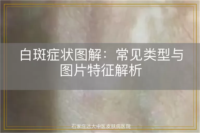 白斑症状图解：常见类型与图片特征解析