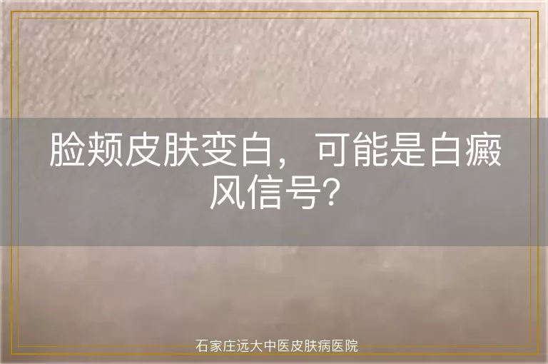 脸颊皮肤变白，可能是白癜风信号？