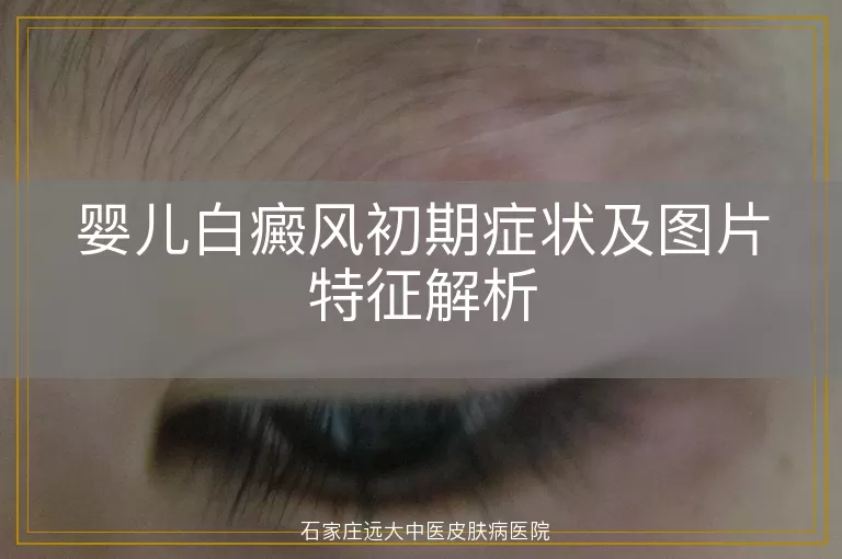 婴儿白癜风初期症状及图片特征解析