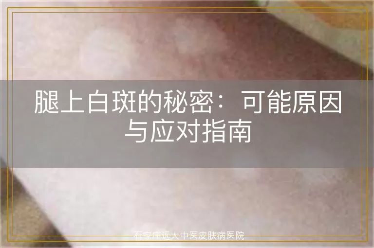 腿上白斑的秘密：可能原因与应对指南