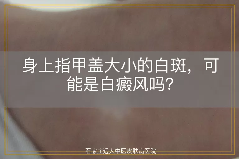 身上指甲盖大小的白斑，可能是白癜风吗？
