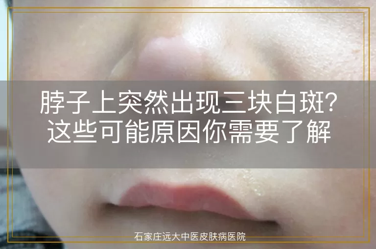 脖子上突然出现三块白斑?这些可能原因你需要了解