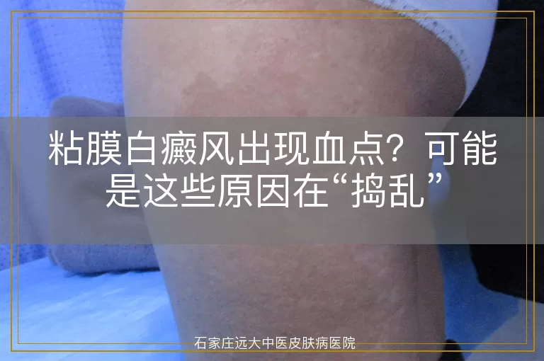 粘膜白癜风出现血点?可能是这些原因在“捣乱”