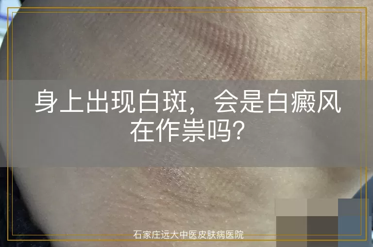 身上出现白斑，会是白癜风在作祟吗？
