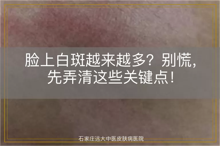 脸上白斑越来越多？别慌，先弄清这些关键点！