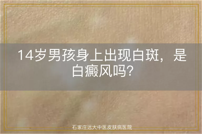 14岁男孩身上出现白斑，是白癜风吗？