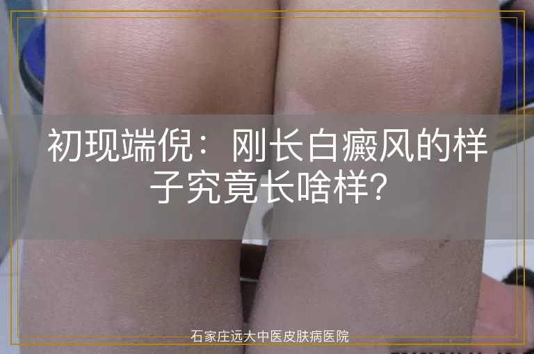 初现端倪：刚长白癜风的样子究竟长啥样？