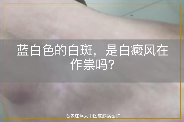 蓝白色的白斑，是白癜风在作祟吗？