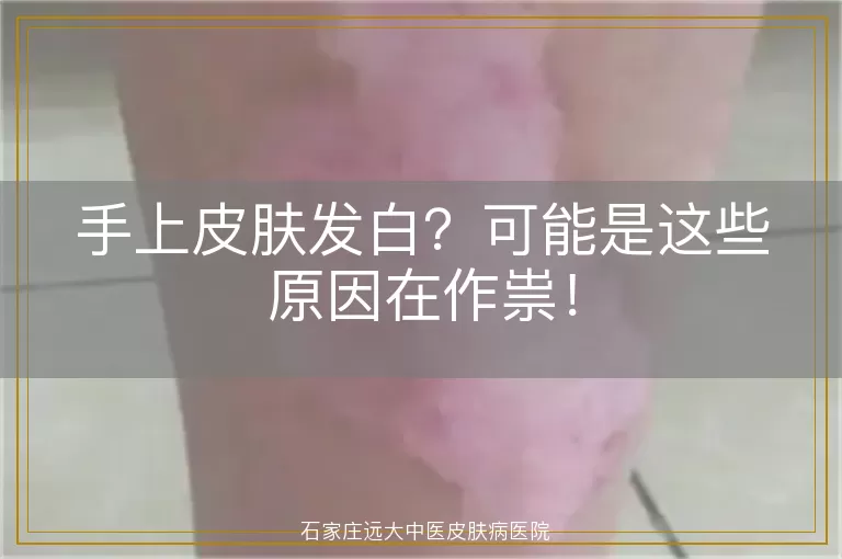手上皮肤发白？可能是这些原因在作祟！