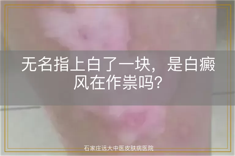 无名指上白了一块，是白癜风在作祟吗？