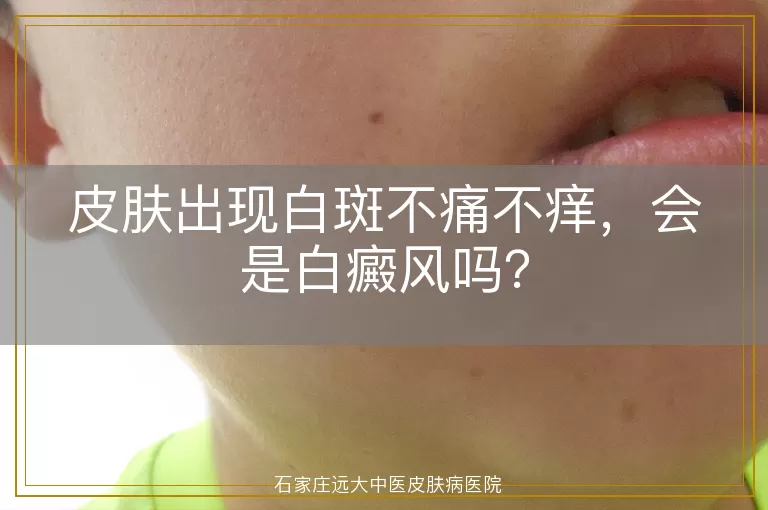 皮肤出现白斑不痛不痒，会是白癜风吗？