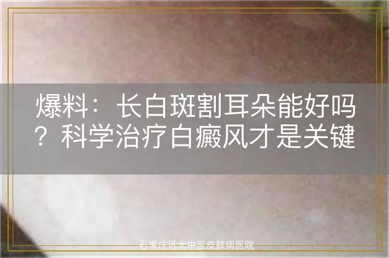 爆料：长白斑割耳朵能好吗？科学治疗白癜风才是关键