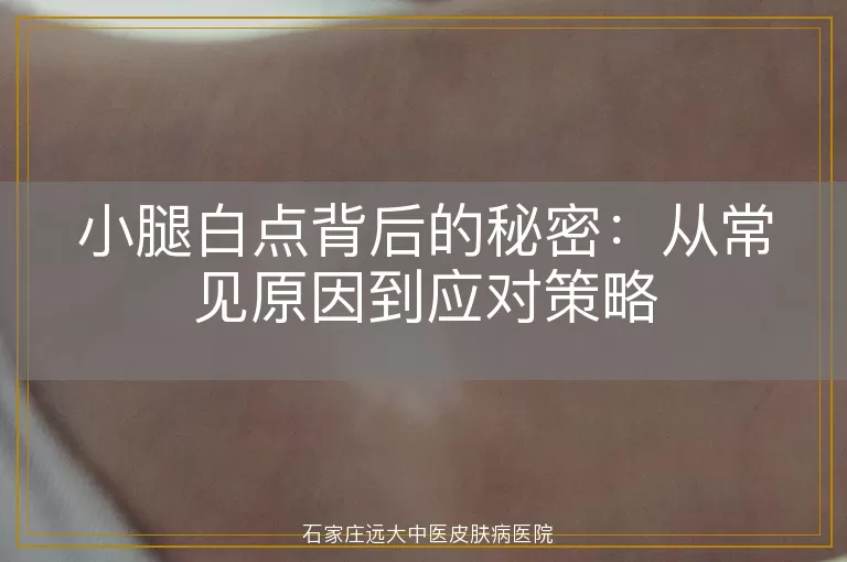 小腿白点背后的秘密：从常见原因到应对策略