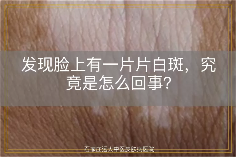 发现脸上有一片片白斑，究竟是怎么回事？