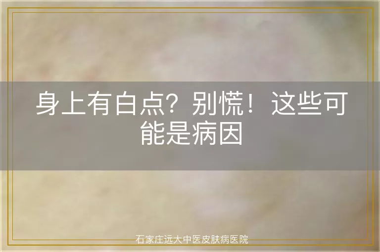 身上有白点？别慌！这些可能是病因