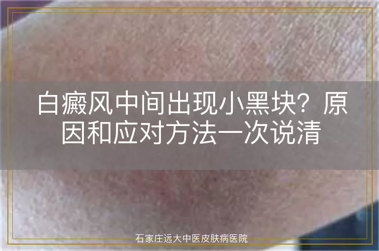 白癜风中间出现小黑块？原因和应对方法一次说清