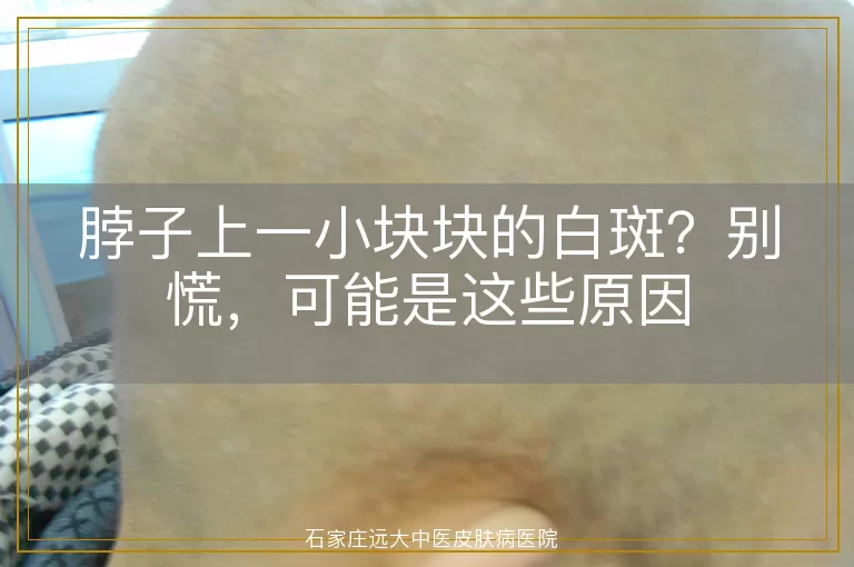 脖子上一小块块的白斑？别慌，可能是这些原因