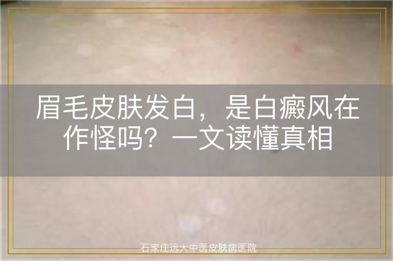 眉毛皮肤发白,是白癜风在作怪吗?一文读懂真相