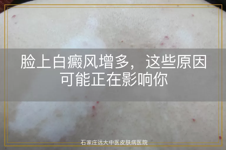 脸上白癜风增多，这些原因可能正在影响你
