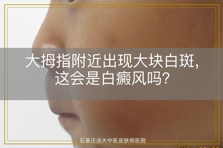 大拇指附近出现大块白斑，这会是白癜风吗？