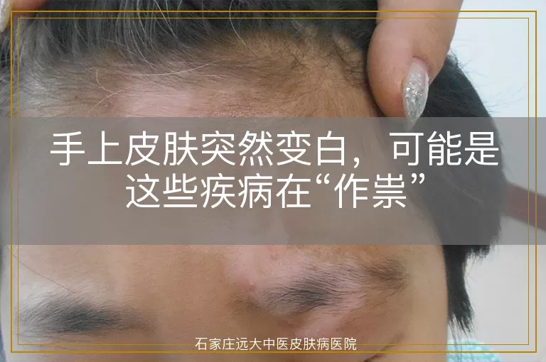 手上皮肤突然变白，可能是这些疾病在“作祟”