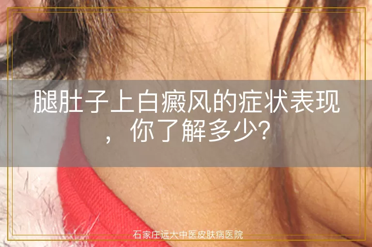 腿肚子上白癜风的症状表现，你了解多少？