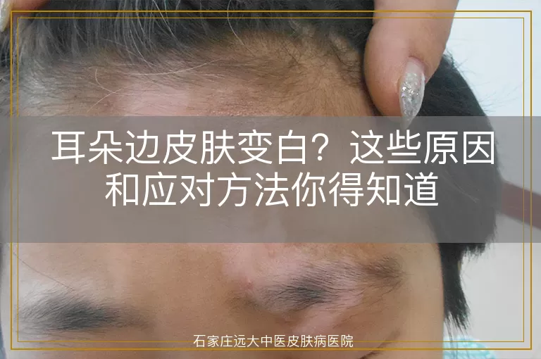 耳朵边皮肤变白?这些原因和应对方法你得知道