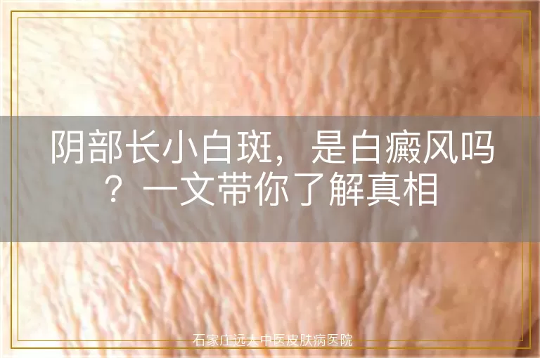阴部长小白斑,是白癜风吗?一文带你了解真相