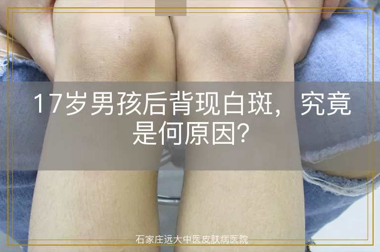 17岁男孩后背现白斑，究竟是何原因？