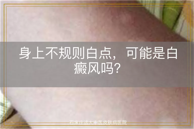 身上不规则白点，可能是白癜风吗？