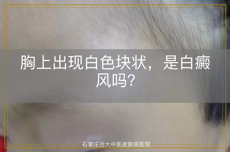 胸上出现白色块状，是白癜风吗？