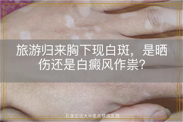 旅游归来胸下现白斑，是晒伤还是白癜风作祟？