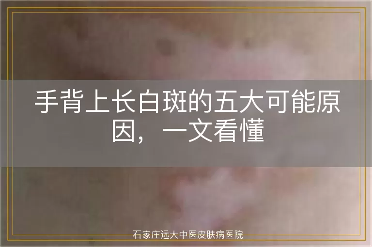 手背上长白斑的五大可能原因，一文看懂
