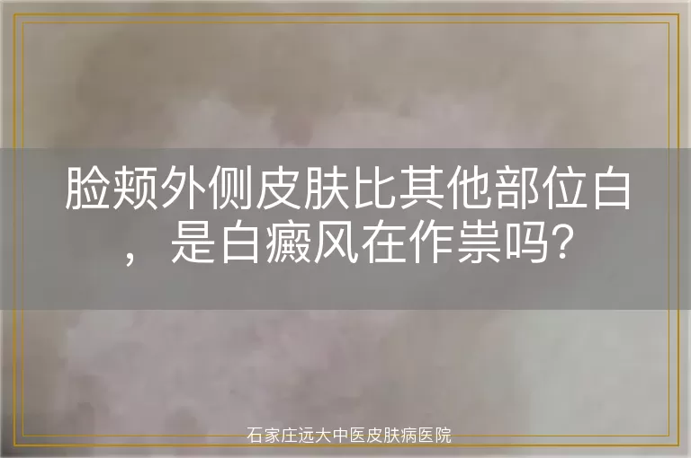 脸颊外侧皮肤比其他部位白，是白癜风在作祟吗？