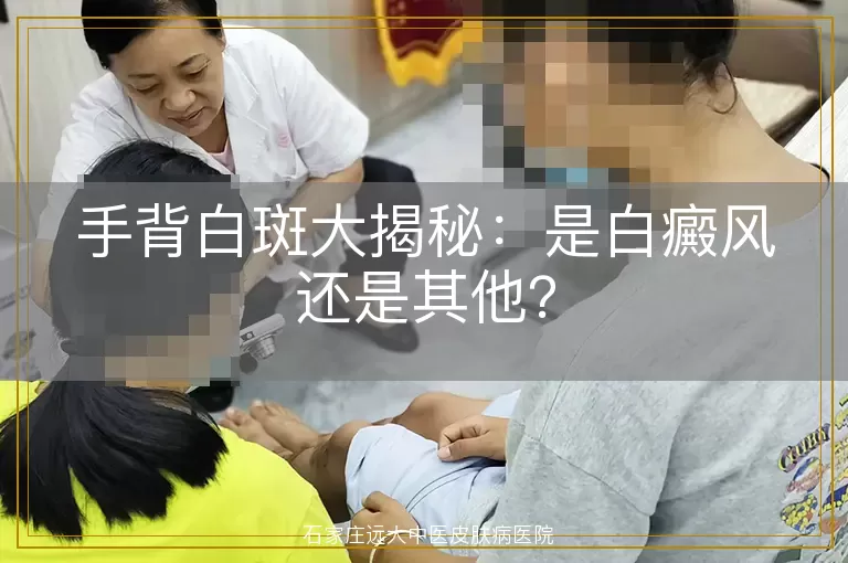 手背白斑大揭秘:是白癜风还是其他?