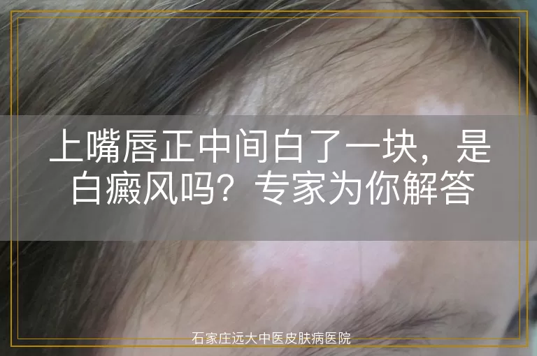 上嘴唇正中间白了一块，是白癜风吗？专家为你解答