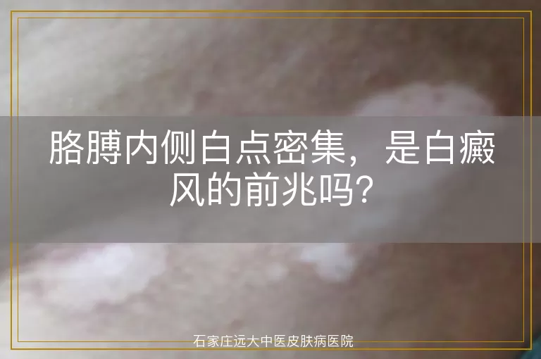 胳膊内侧白点密集，是白癜风的前兆吗？