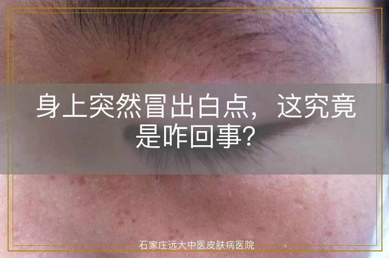 身上突然冒出白点，这究竟是咋回事？