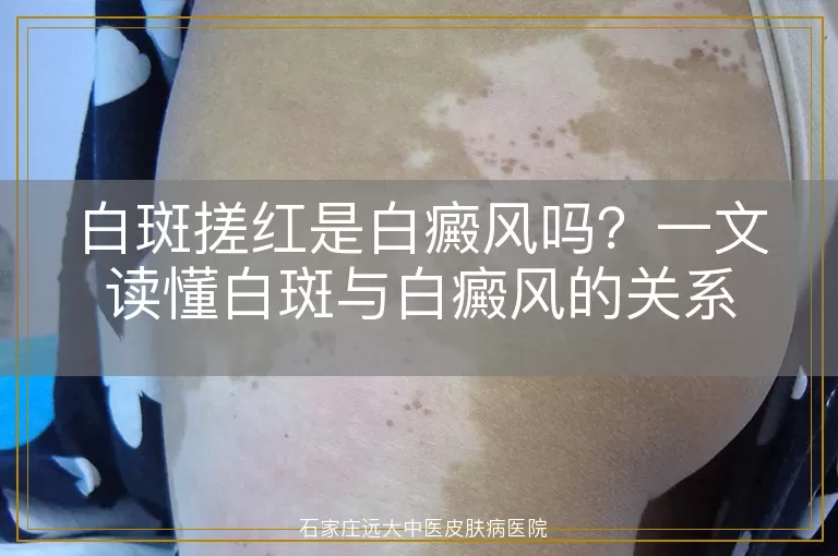 白斑搓红是白癜风吗？一文读懂白斑与白癜风的关系