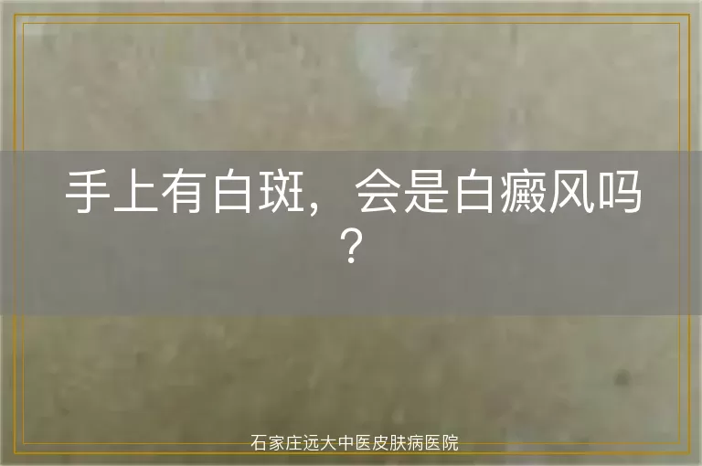 手上有白斑，会是白癜风吗？