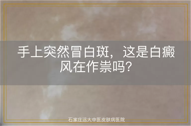 手上突然冒白斑，这是白癜风在作祟吗？