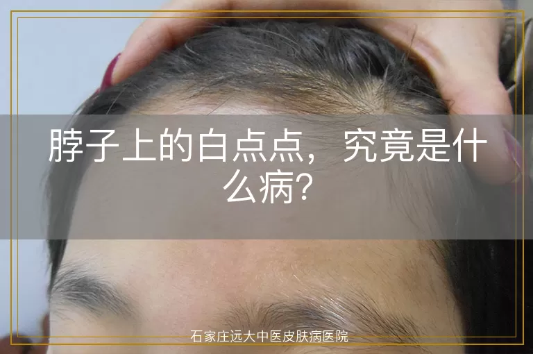 脖子上的白点点，究竟是什么病？