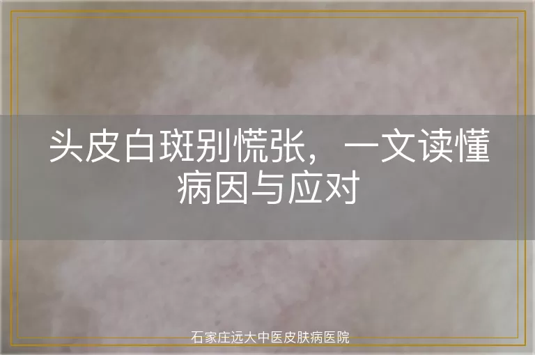 头皮白斑别慌张，一文读懂病因与应对